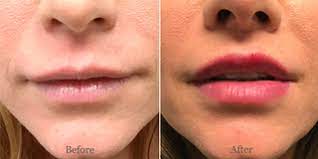 philtrum reduction