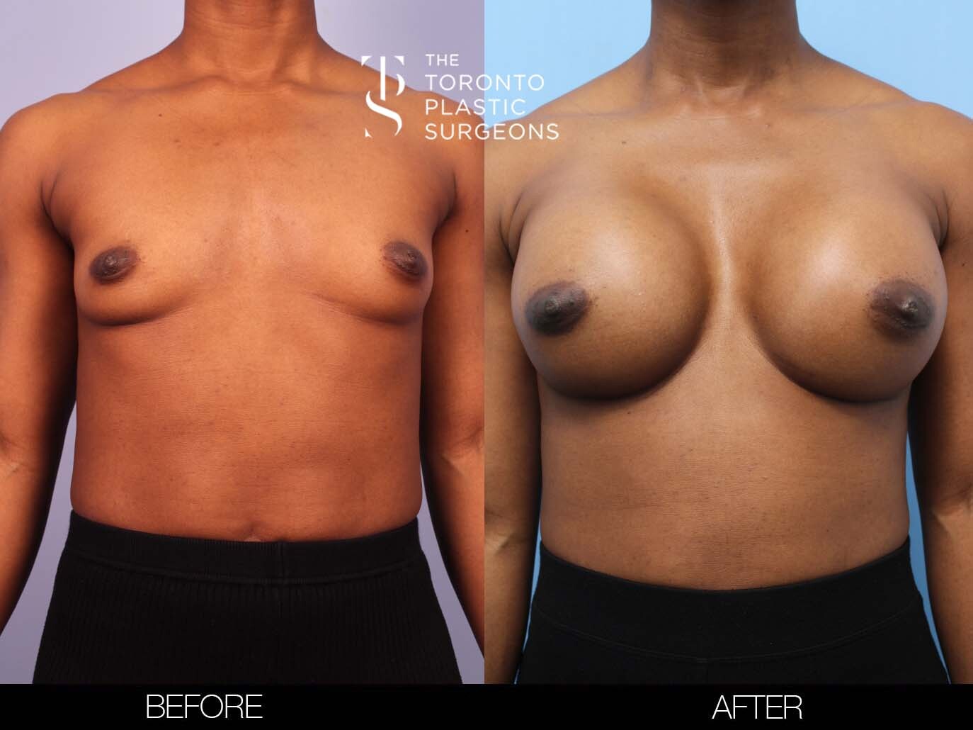 plastic boobs plastic boobs