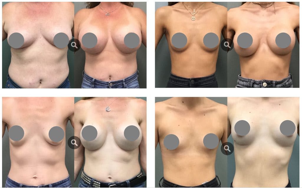 plastic surgery boobs plastic surgery boobs