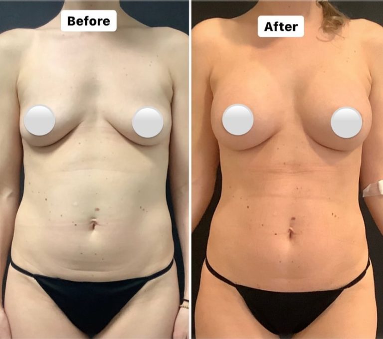 Plastic Surgery Boobs: Exploring enhancement options