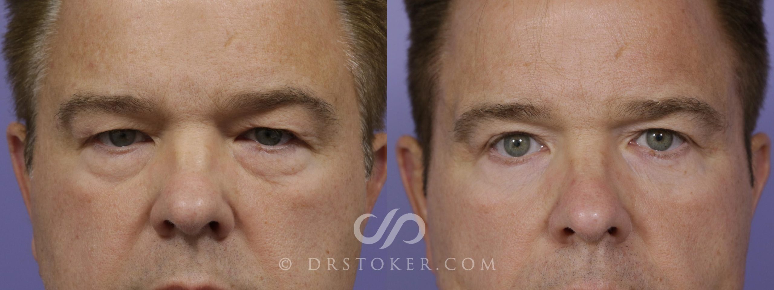 plastic surgery for men plastic surgery for men
