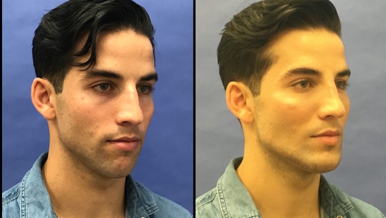 Plastic surgery for men: Procedures gaining popularity
