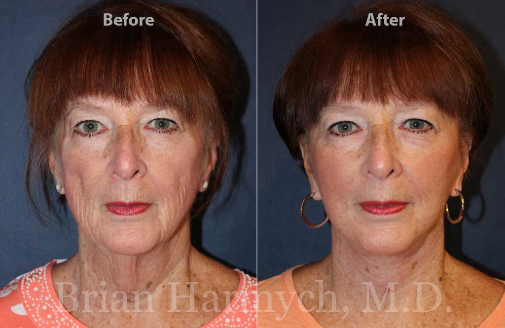 platysmaplasty cost