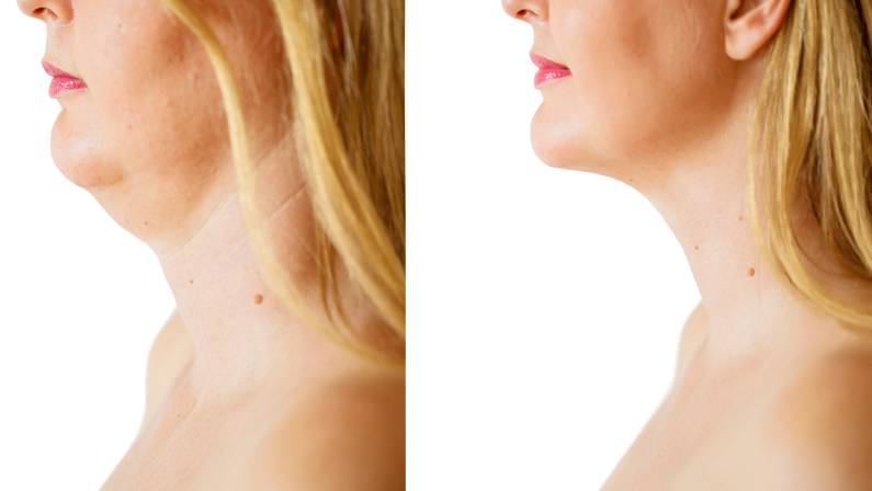 platysmaplasty cost