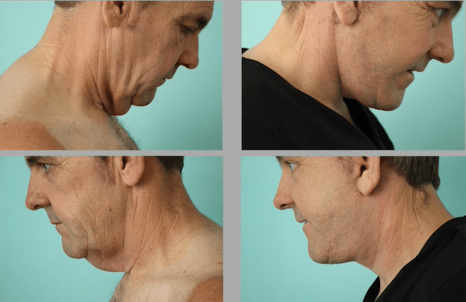 Platysmaplasty cost: Smoothing and tightening the neck