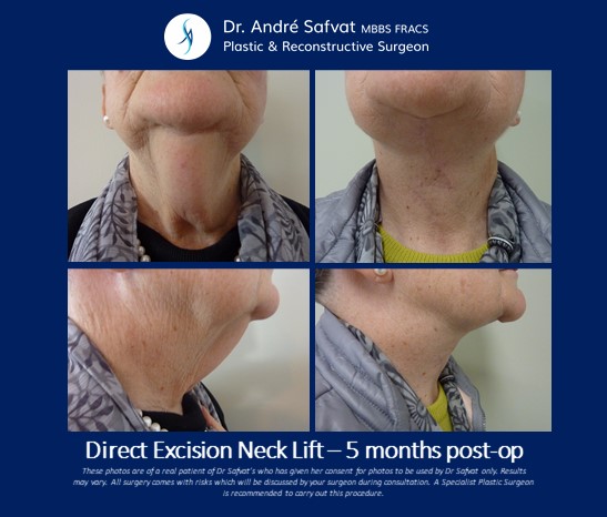 platysmaplasty platysmaplasty