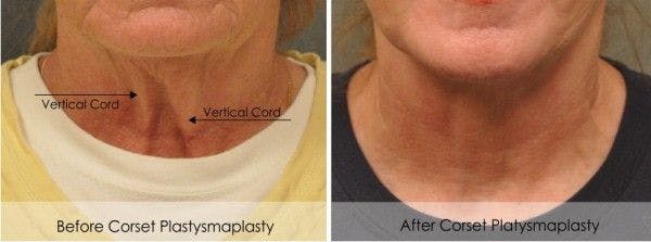 platysmaplasty platysmaplasty