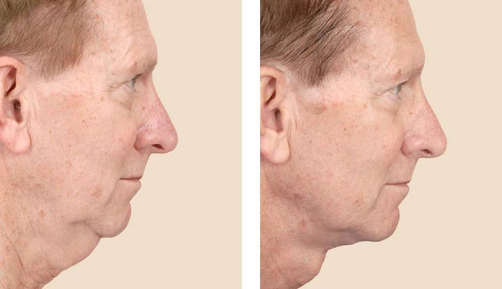 Platysmaplasty: Tightening and rejuvenating the neck area