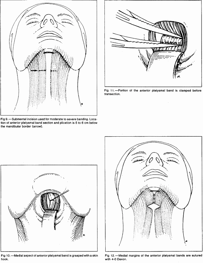 platysmaplasty platysmaplasty