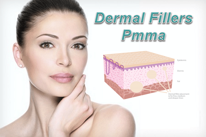 PMMA injections: Long-lasting solutions for body contouring