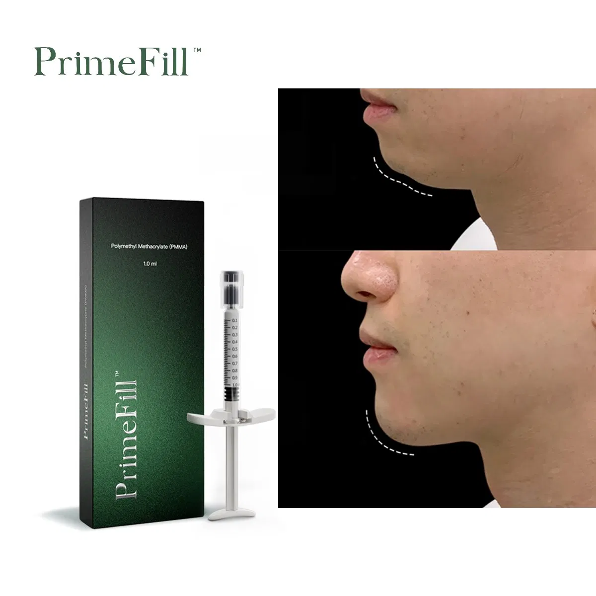 pmma injections