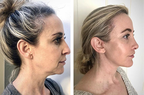 ponytail lift cost ponytail lift cost