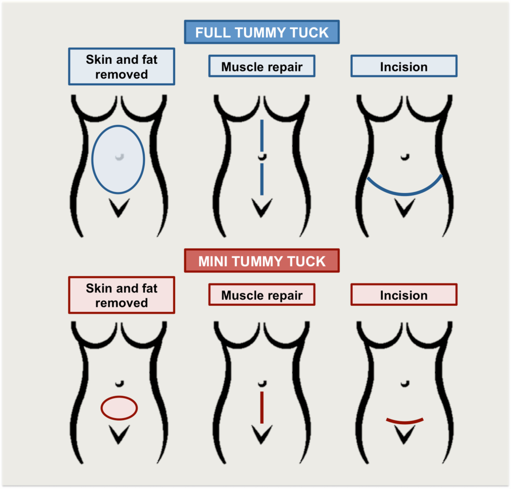 pregnancy after tummy tuck pregnancy after tummy tuck
