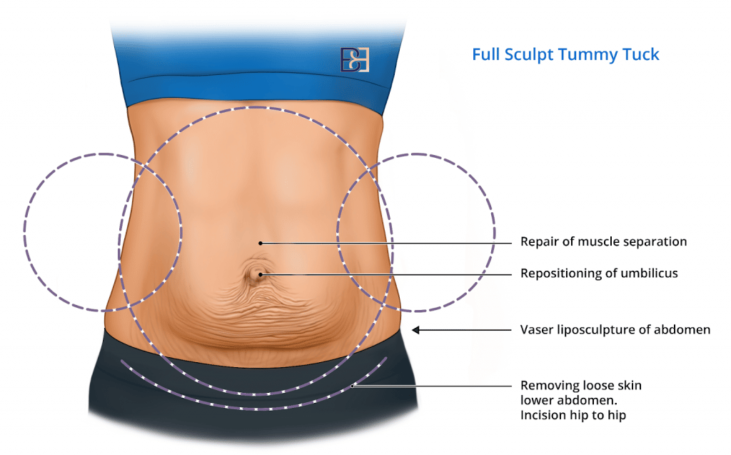 pregnancy after tummy tuck pregnancy after tummy tuck