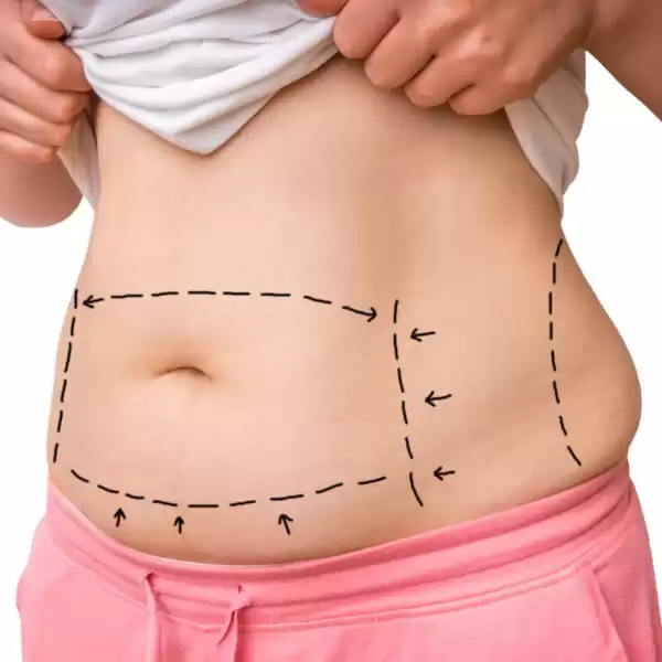 pregnancy after tummy tuck pregnancy after tummy tuck