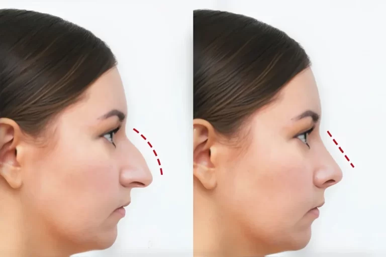 Reduction Rhinoplasty: Refining nasal shape and size