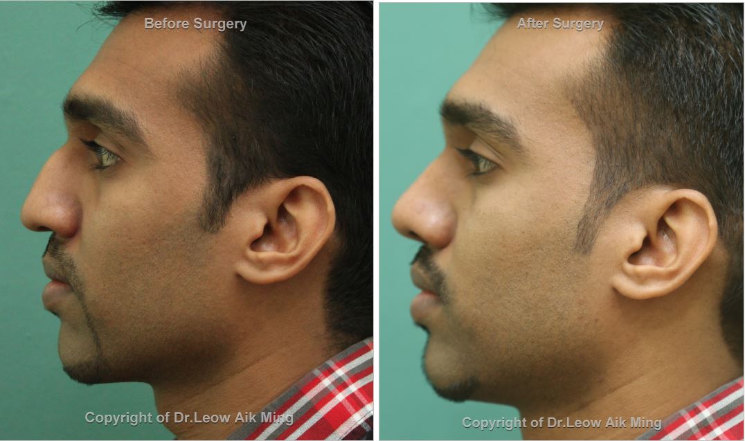 reduction rhinoplasty reduction rhinoplasty