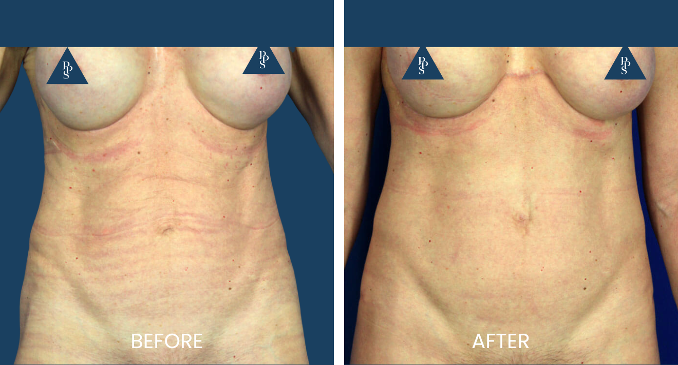reverse tummy tuck reverse tummy tuck