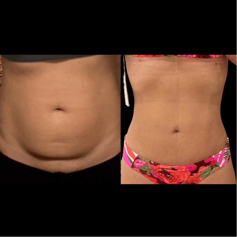 reverse tummy tuck reverse tummy tuck