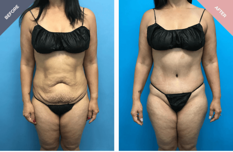 Reverse Tummy Tuck: Upper abdominal tightening