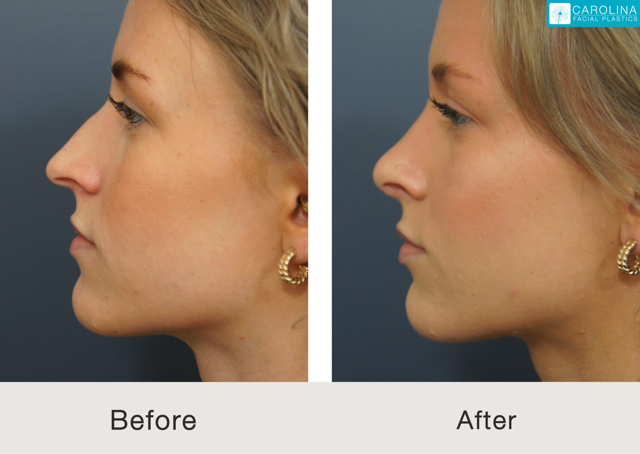 rhinoplasty rhinoplasty