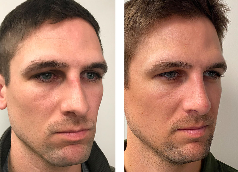 rhinoplasty rhinoplasty