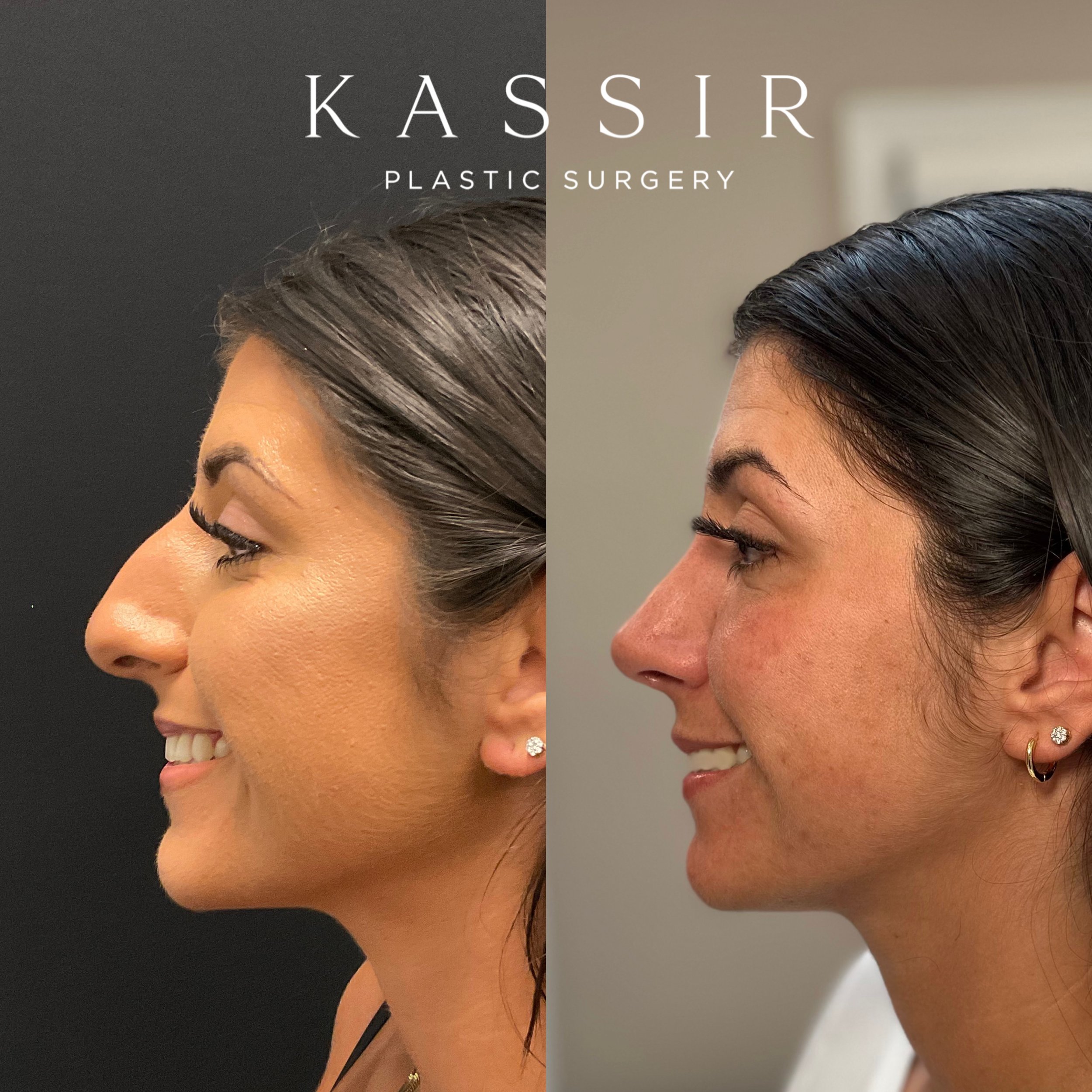 rhinoplasty rhinoplasty