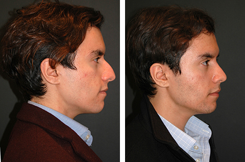 rhinoplasty men