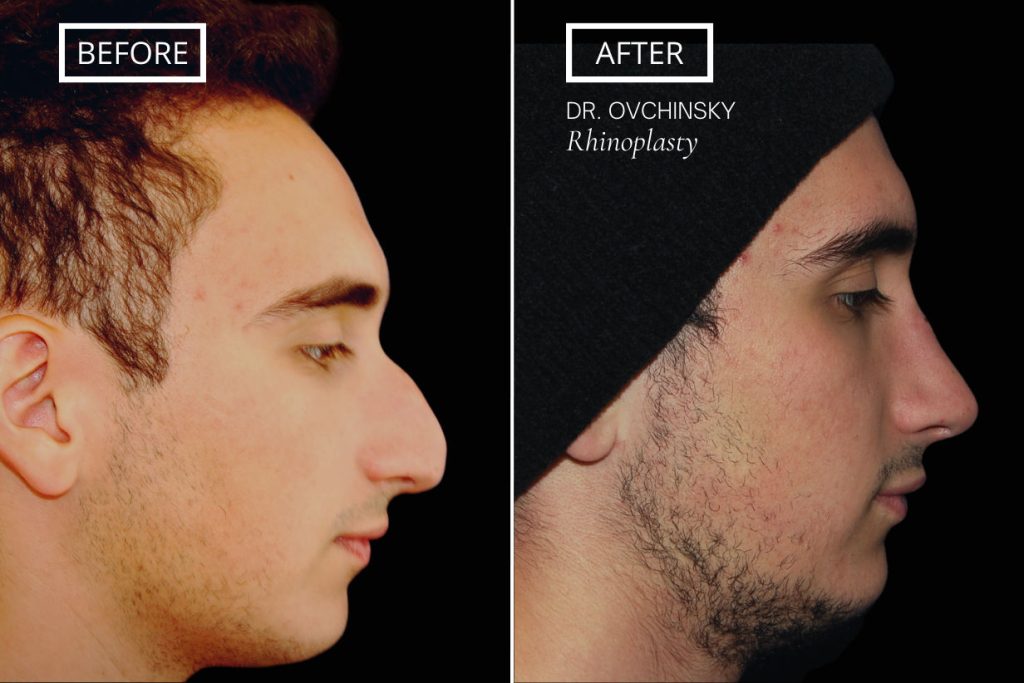 rhinoplasty men