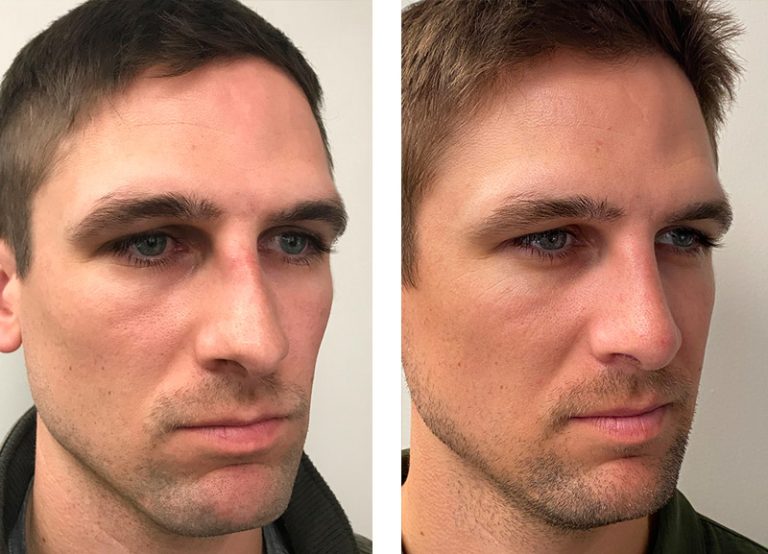 Rhinoplasty Men: Tailored solutions for male nasal reshaping