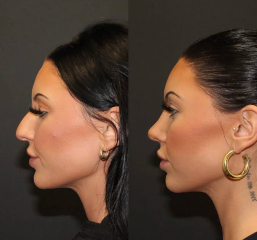 rhinoplasty price rhinoplasty price