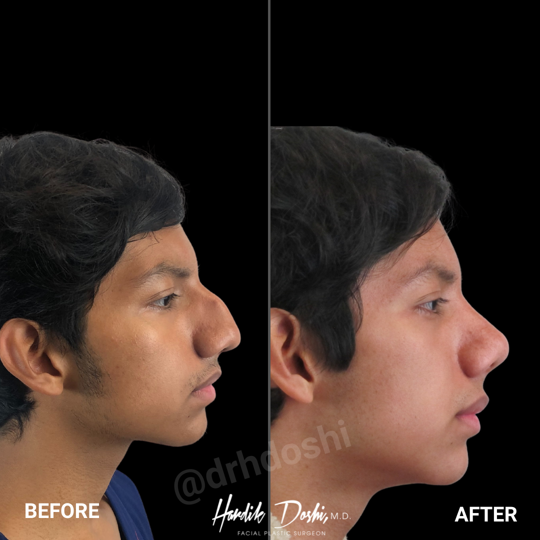 rhinoplasty price rhinoplasty price