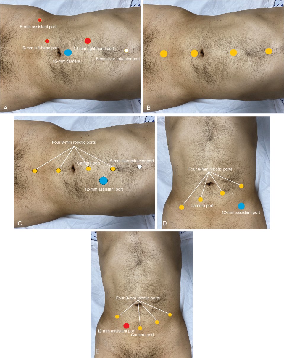 rplnd surgery