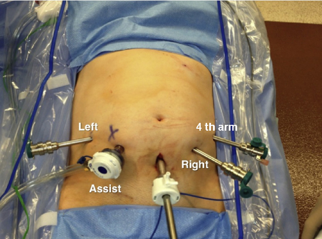 rplnd surgery