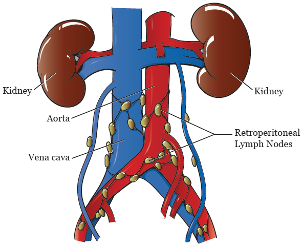 RPLND Surgery: A guide to retroperitoneal lymph node dissection