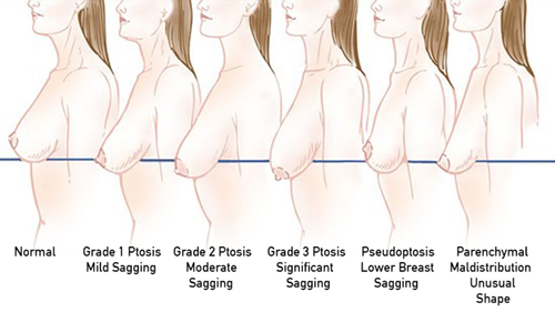 sagging breast