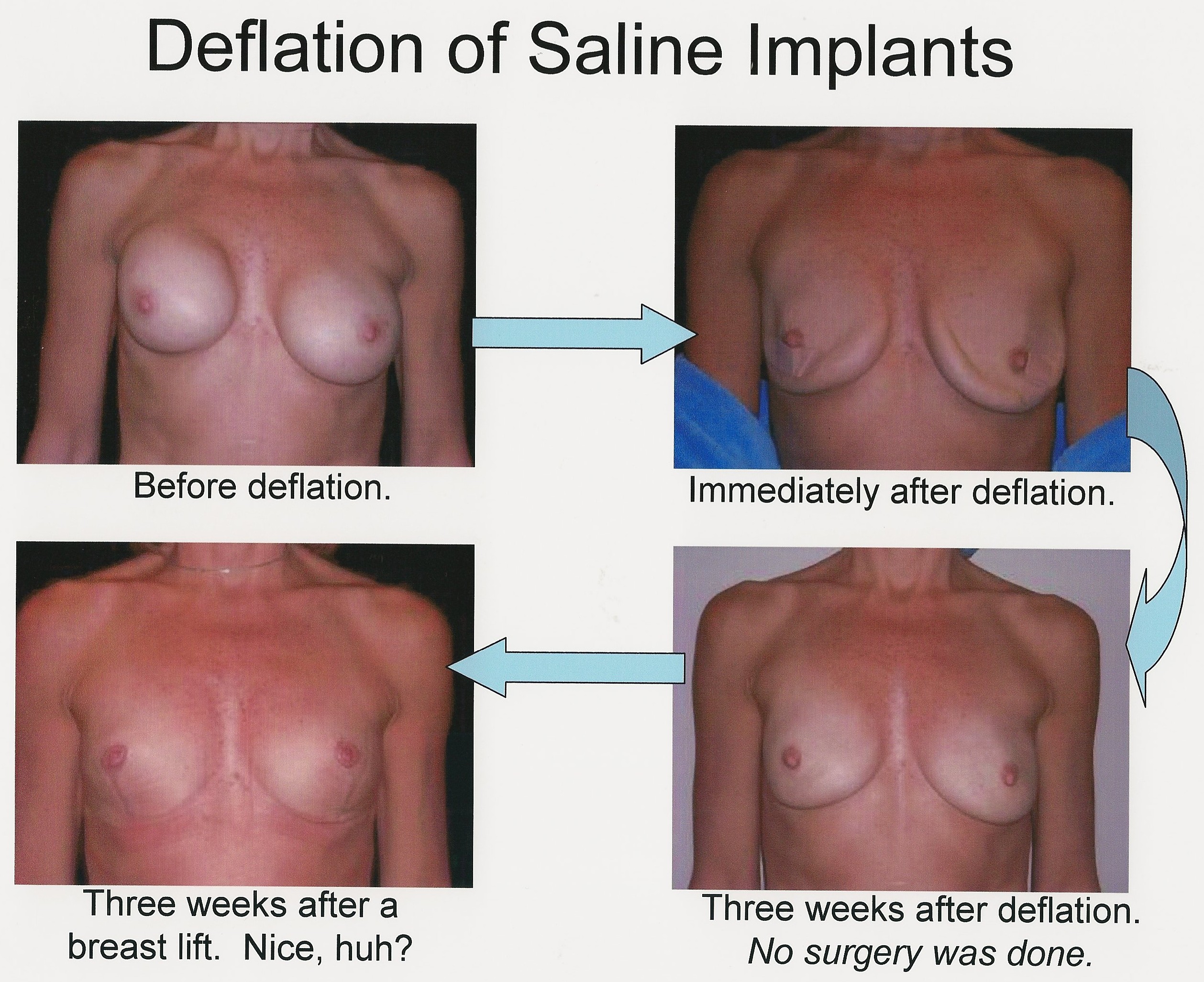 saline breast injections