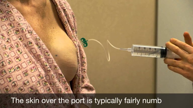 Saline breast injections: Temporary enhancement solutions