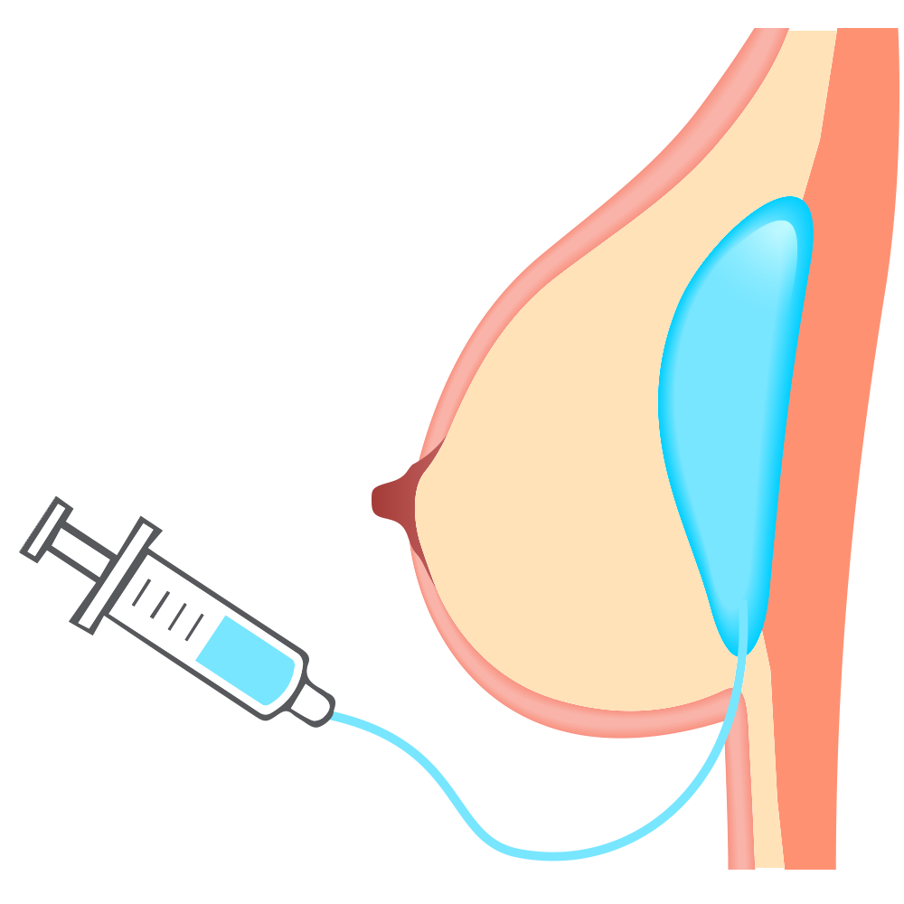 saline breast injections