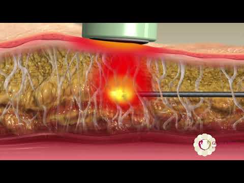 scarless breast lift