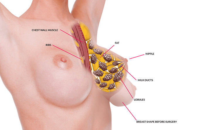 Scarless breast lift: Achieving results without visible marks