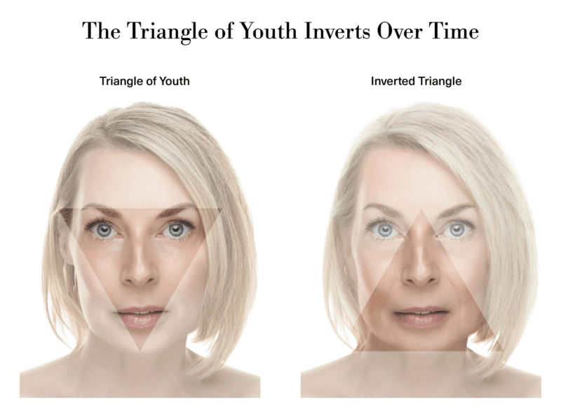 sculptra face lift