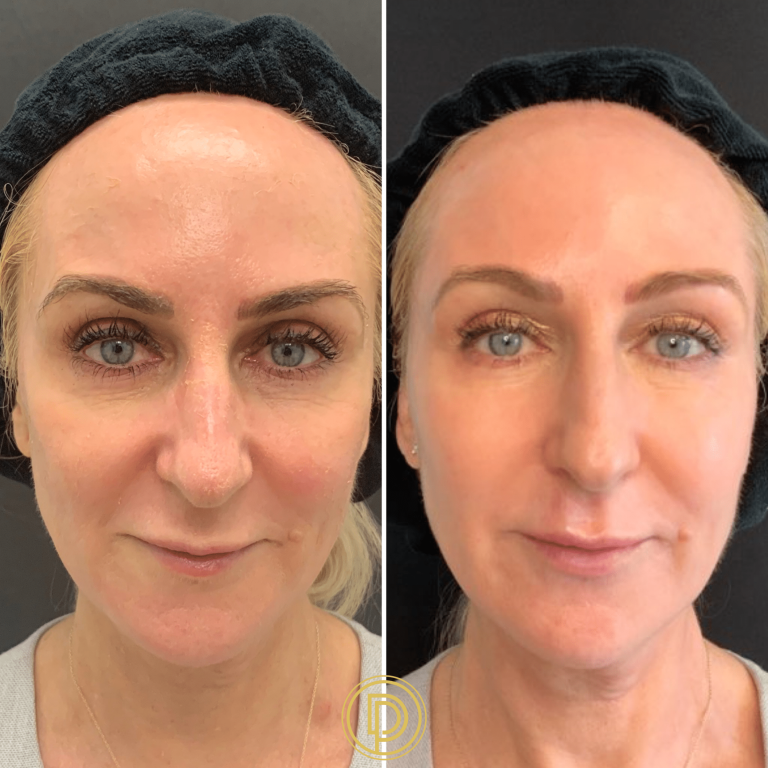Sculptra face lift: Rejuvenation without invasive procedures