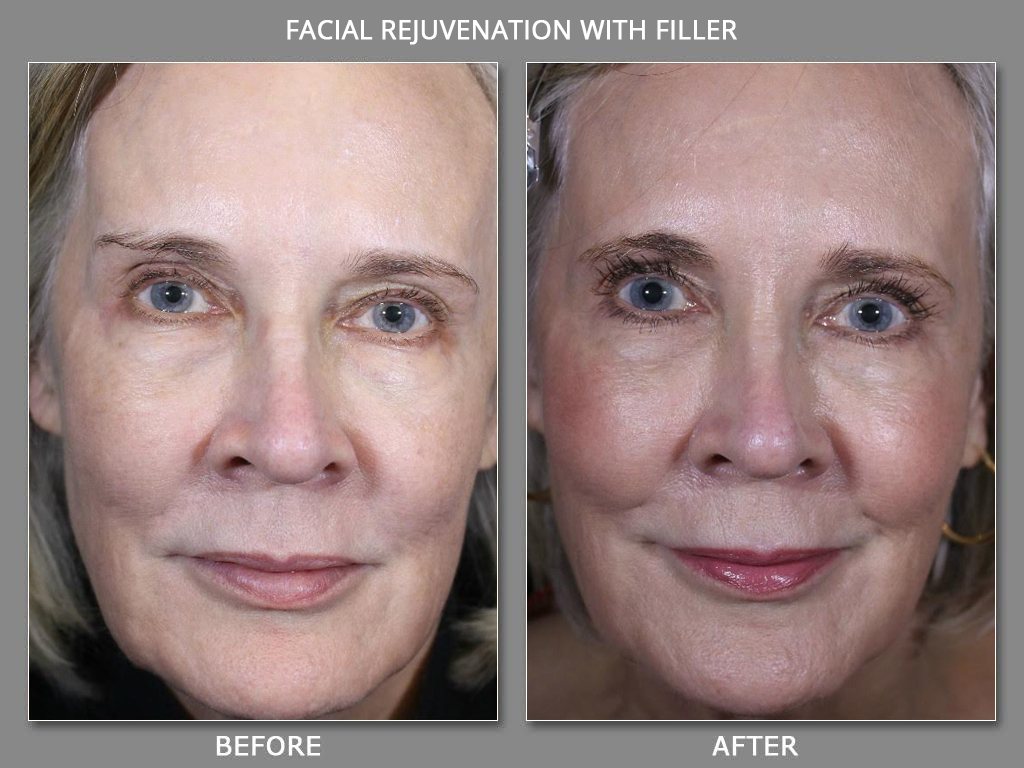sculptra face lift