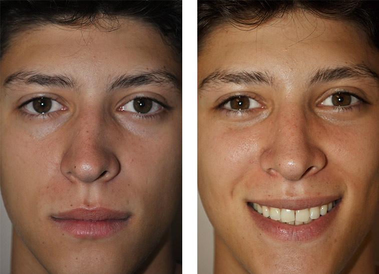 septorhinoplasty cost septorhinoplasty cost