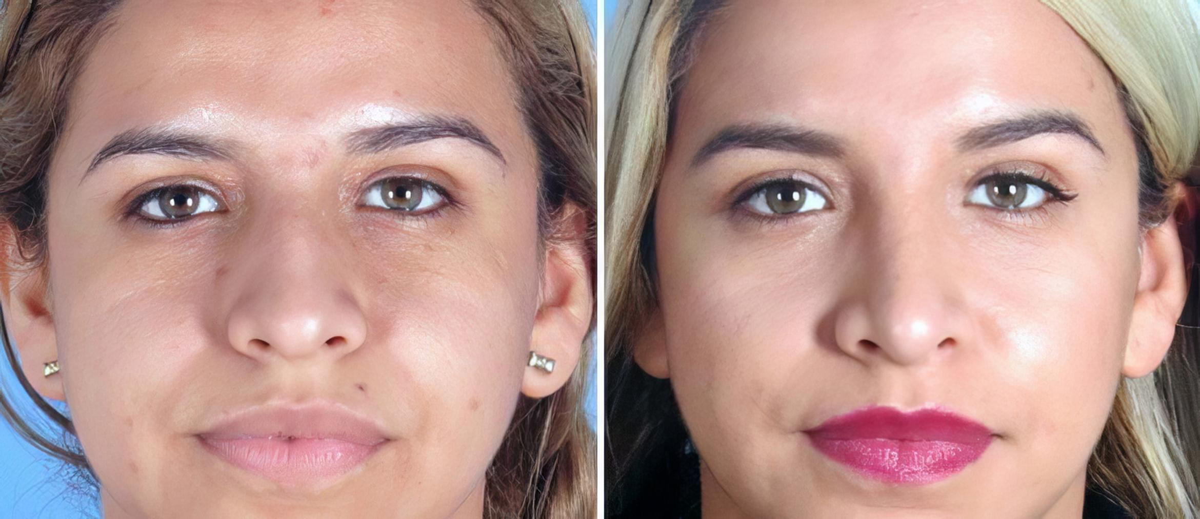 septorhinoplasty cost septorhinoplasty cost
