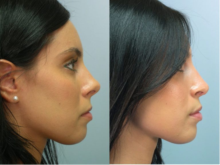 Septorhinoplasty cost: Combining function and form in nose surgery