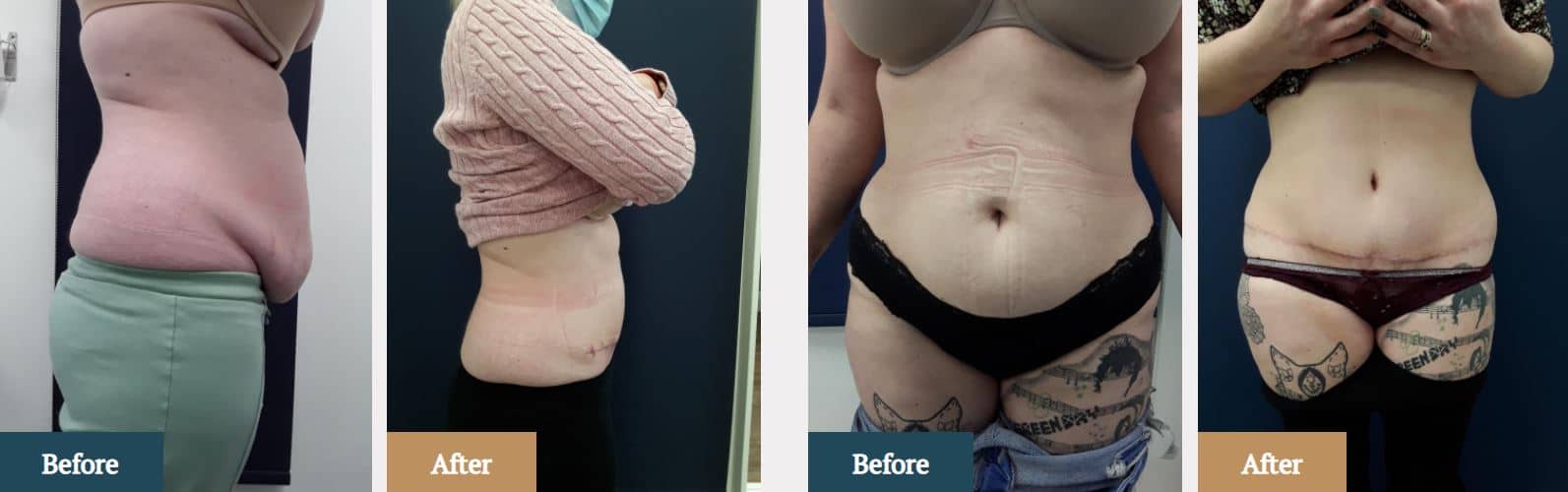 skin removal after weight loss skin removal after weight loss