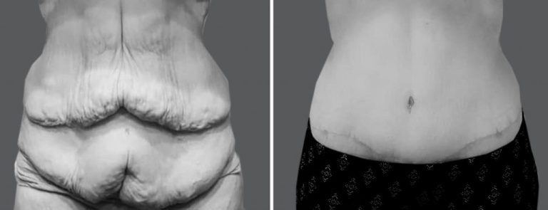 Skin removal after weight loss: Regaining confidence post-transformation