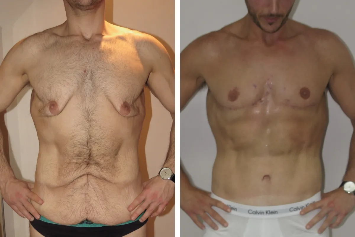 skin removal after weight loss skin removal after weight loss